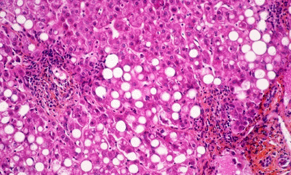 Image: Light micrograph of a section through a liver affected by the Hepatitis C virus (photo courtesy ISM/SPL).